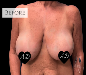 Breast Reduction